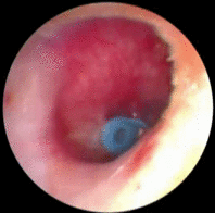Los tubos de timpanostomía y la adenoidectomía mejoran la audición a corto plazo en las otitis medias serosas