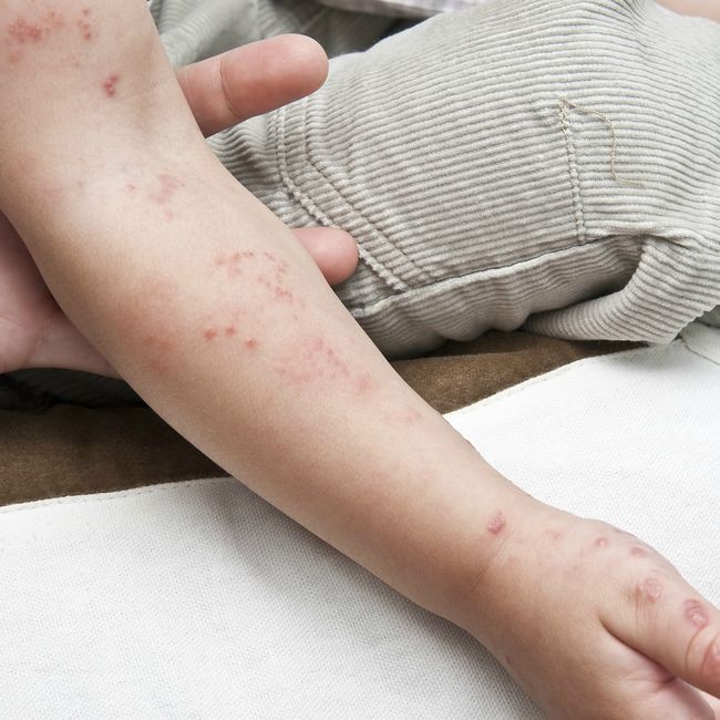 El riesgo de herpes zóster es mayor tras la infección natural que tras la vacunación